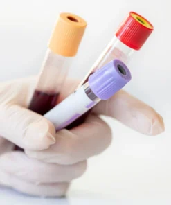 CHROMOSOME BREAKAGE STUDY (FANCONI ANEMIA )