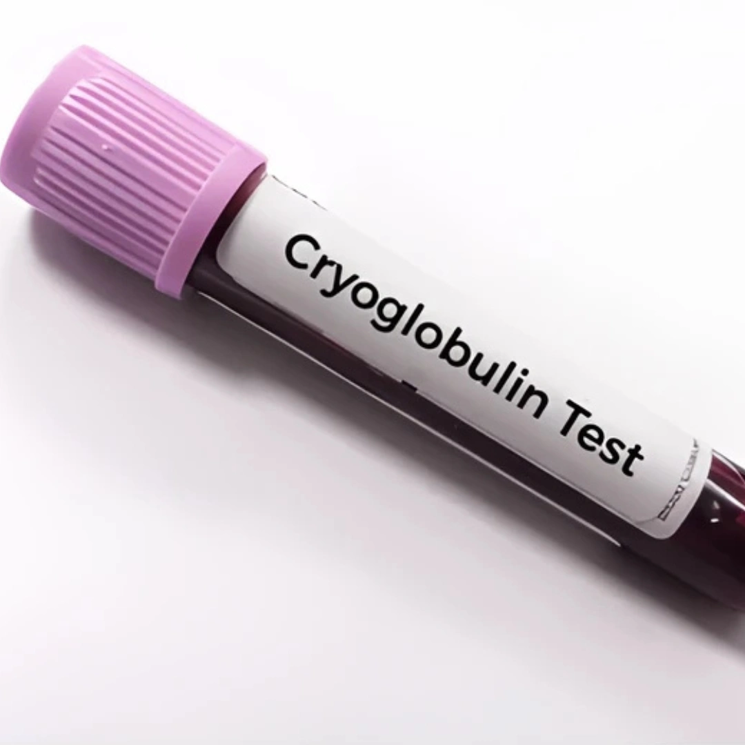 CRYOGLOBULIN- QUALITATIVE