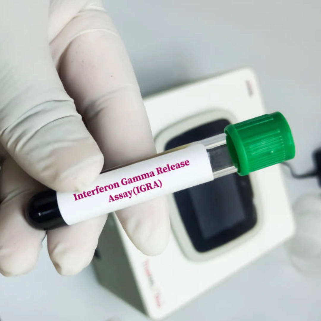 TB - FERON , INTERFERON GAMMA RELEASE ASSAY, BLOOD