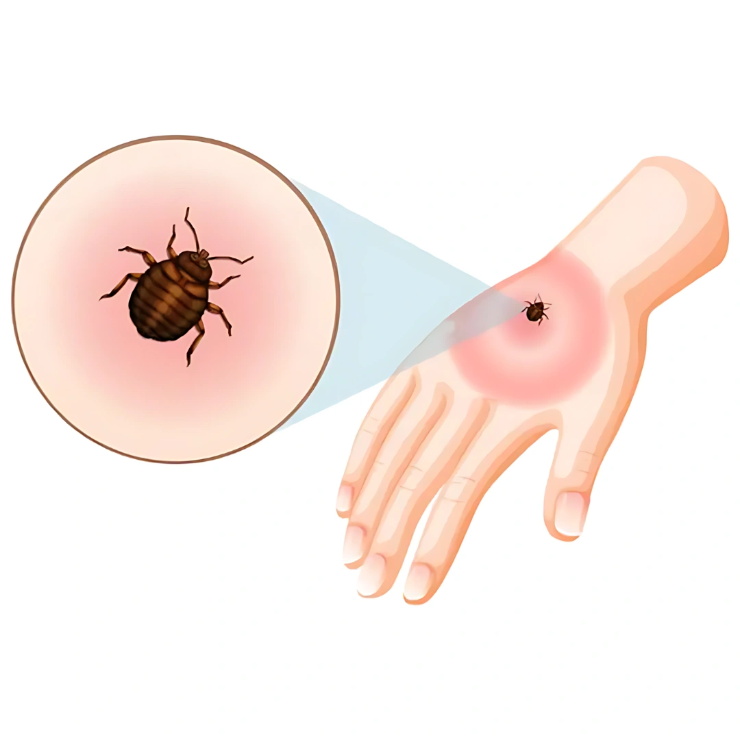Scrub Typhus Igm Antibody