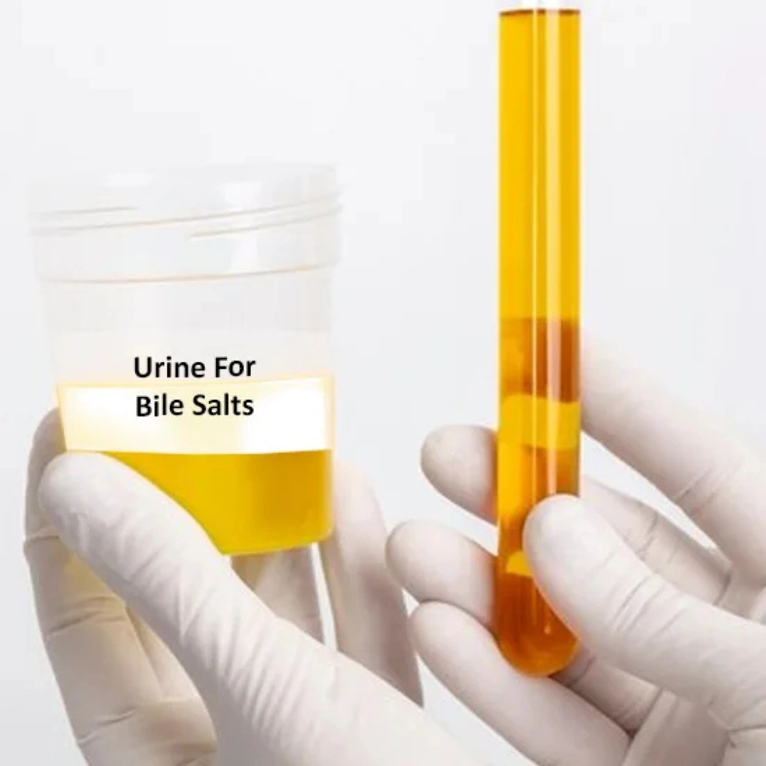 URINE BILE SALTS AND PIGMENTS