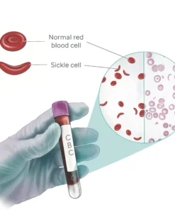 Sickling Test, Whole Blood