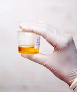 UREA, RANDOM URINE