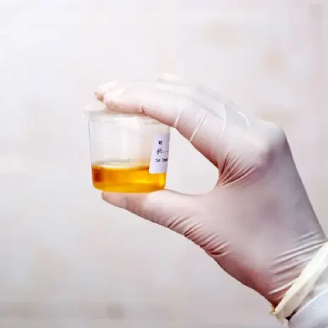 CATECHOLAMINES 24 HR URINE