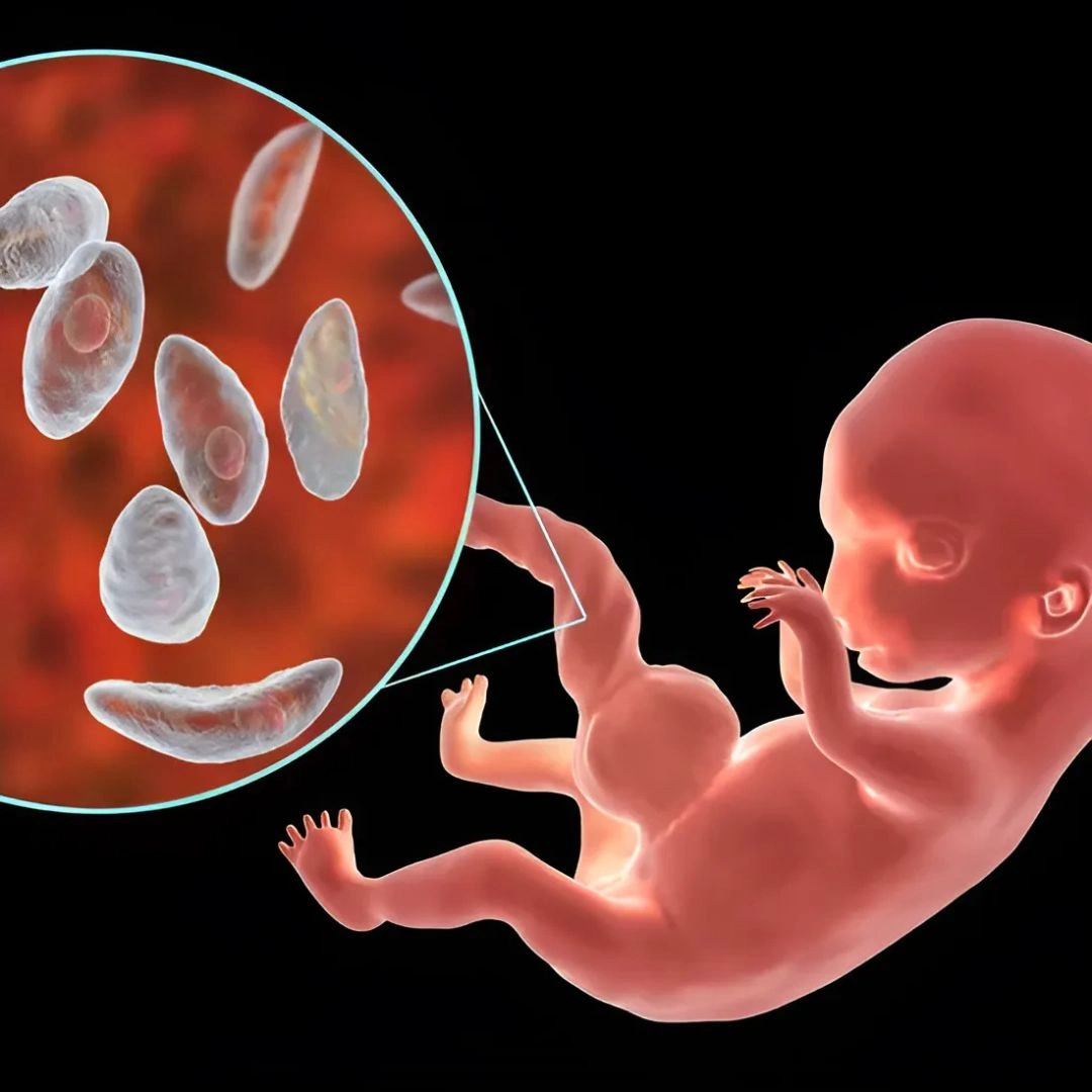 TOXOPLASMA IGG & REFLEX AVIDITY