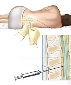 CSF FOR OLIGOCLONAL BANDS
