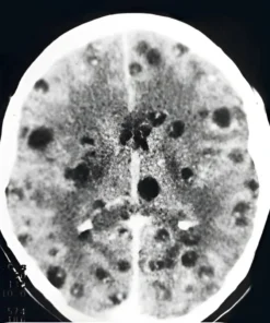 CYSTICERCUS IGG ANTIBODIES