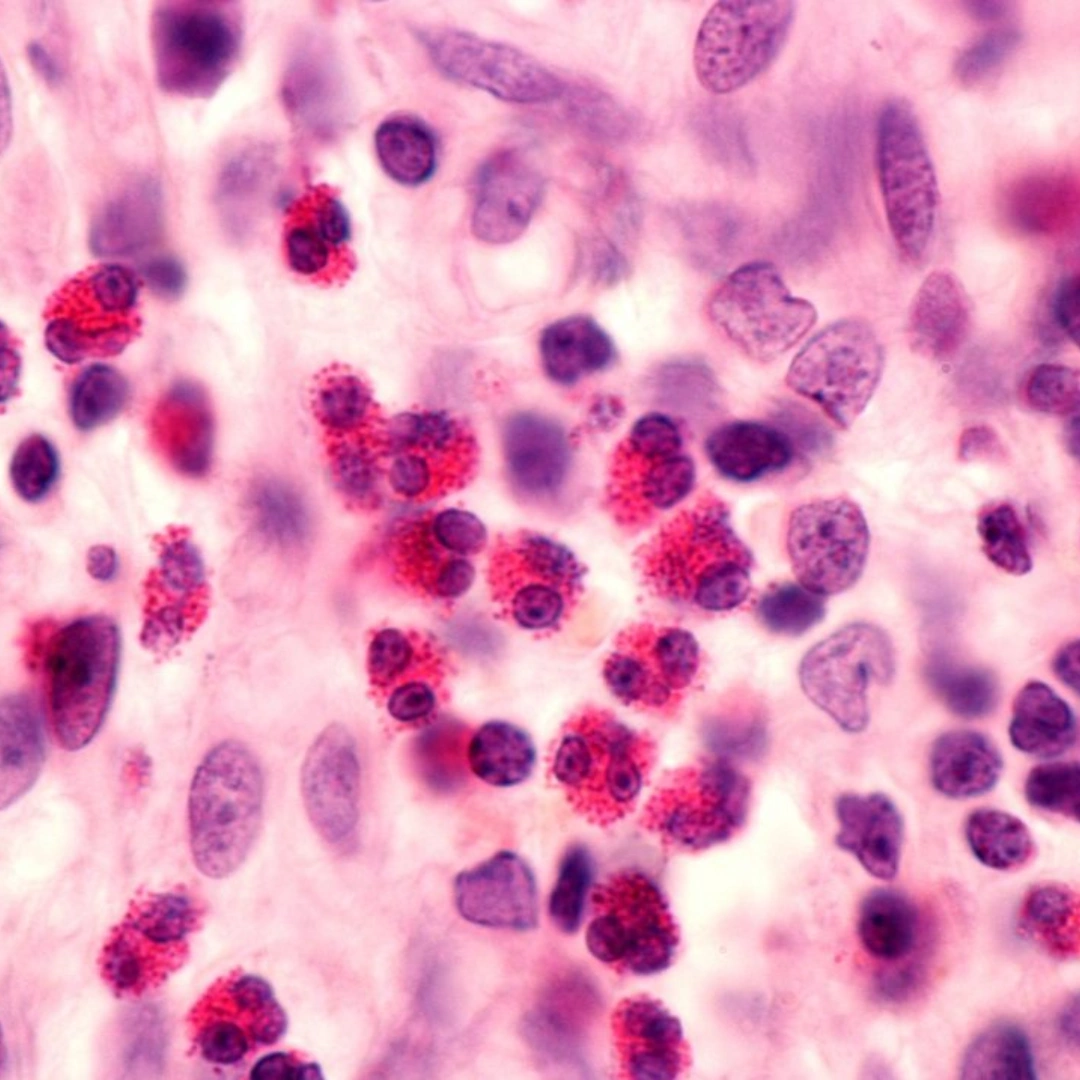 Sputum For Eosinophil