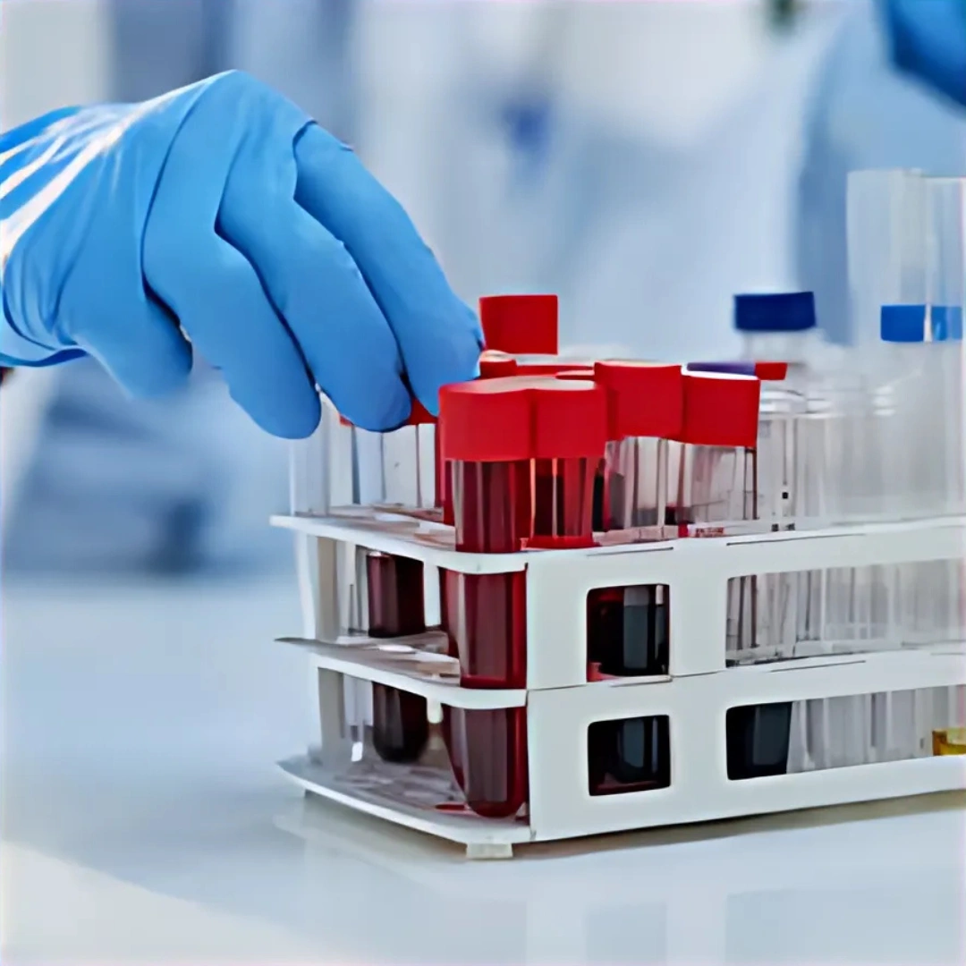 DCP-DECARBOXY PROTHROMBIN PIVKA-II