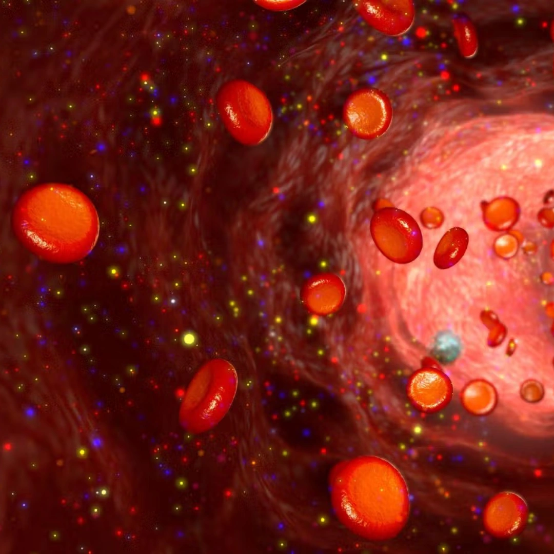 DELETION 11Q ATM (CLL) LEUKEMIC BLOOD
