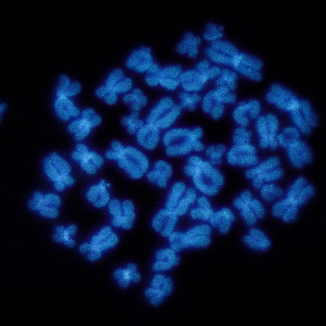 DELETION 17P, P53 (M MYE- LOMA, CLL) LEUKEMIC FISH
