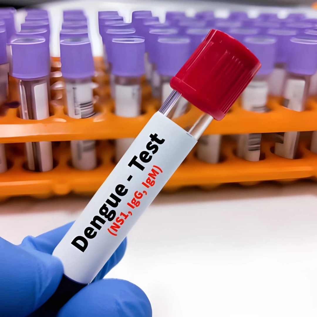 DENGUE IGM, IGG ANTI- BODY, RAPID, SERUM