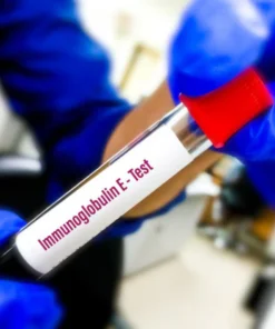 TOTAL IGE(IMMUNO- GLOBULIN E), SERUM