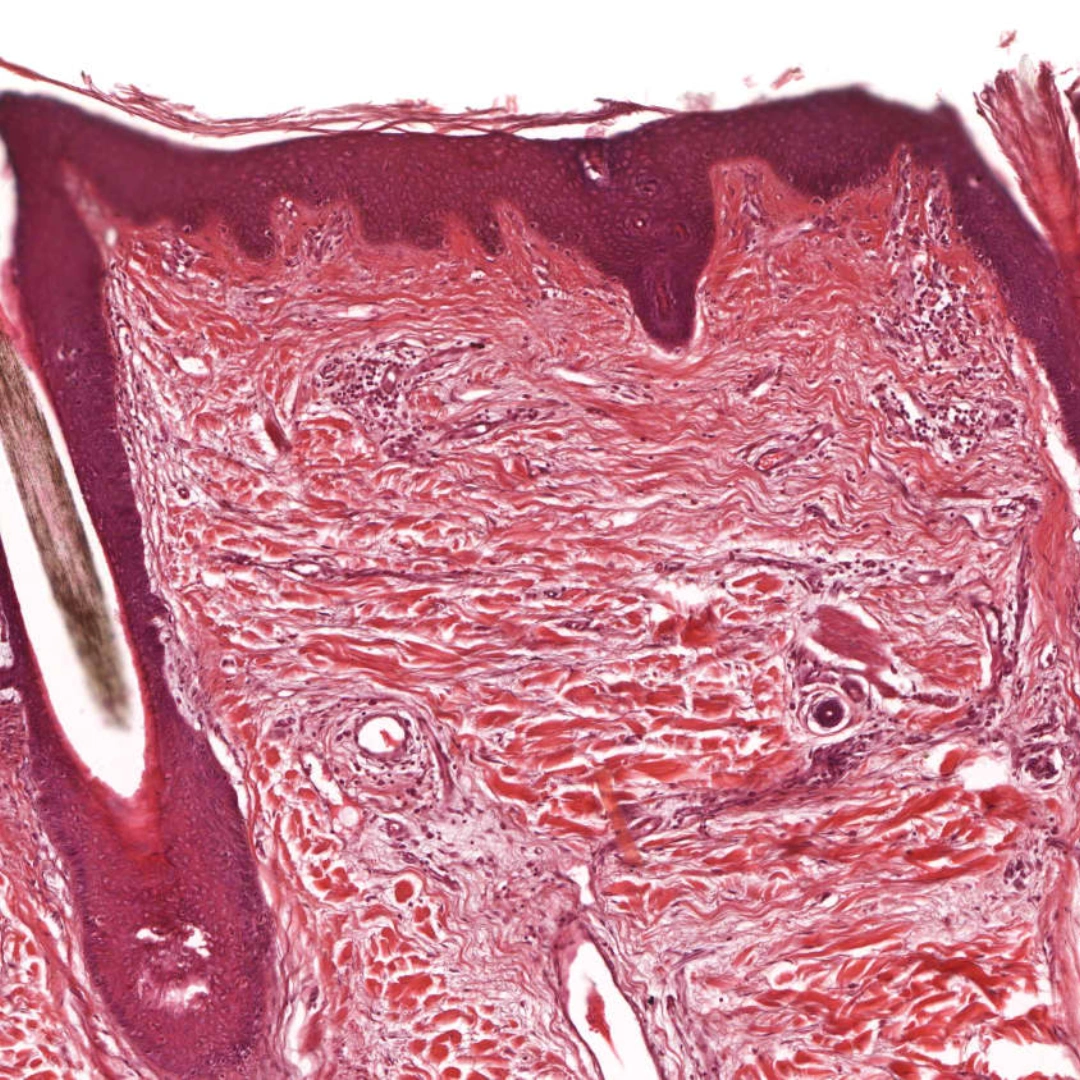 Histopathological Examination Of Skin Biopsy