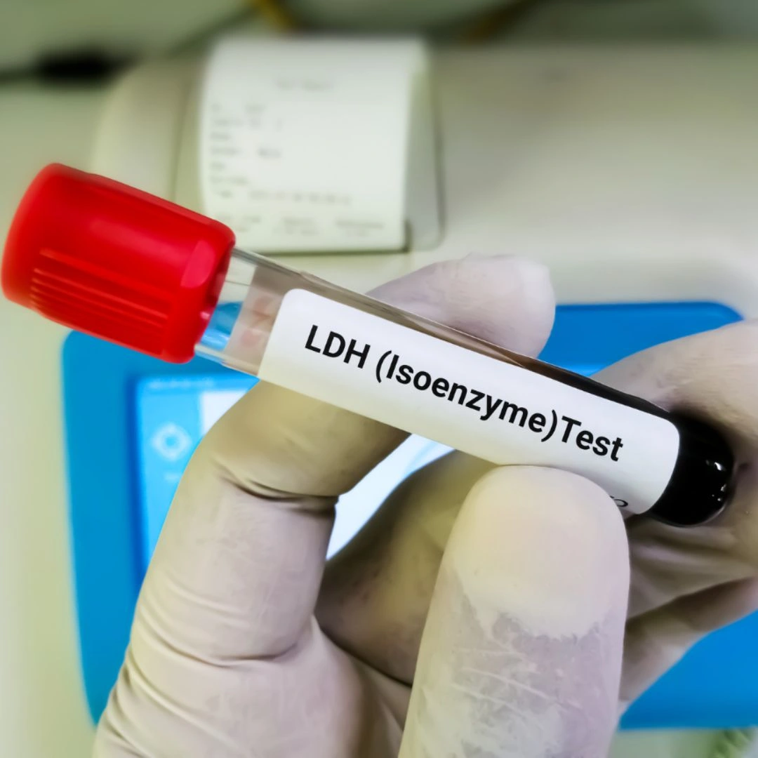 Lactate Dehydrogenase (Ldh), Fluid
