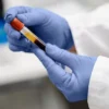 Hiv Detection (Qualitative) Test