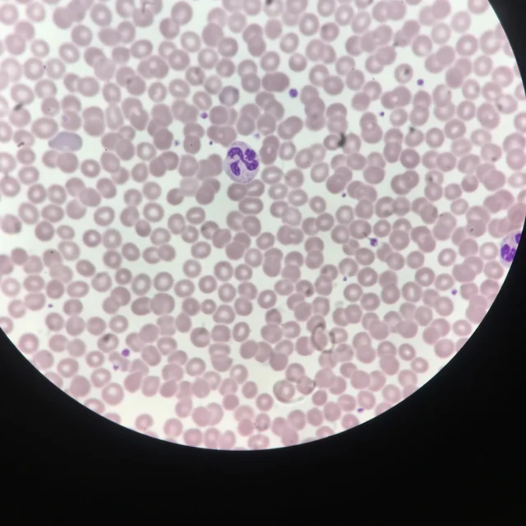 DIFFERENTIAL LEUKOCYTE COUNT, WHOLE BLOOD