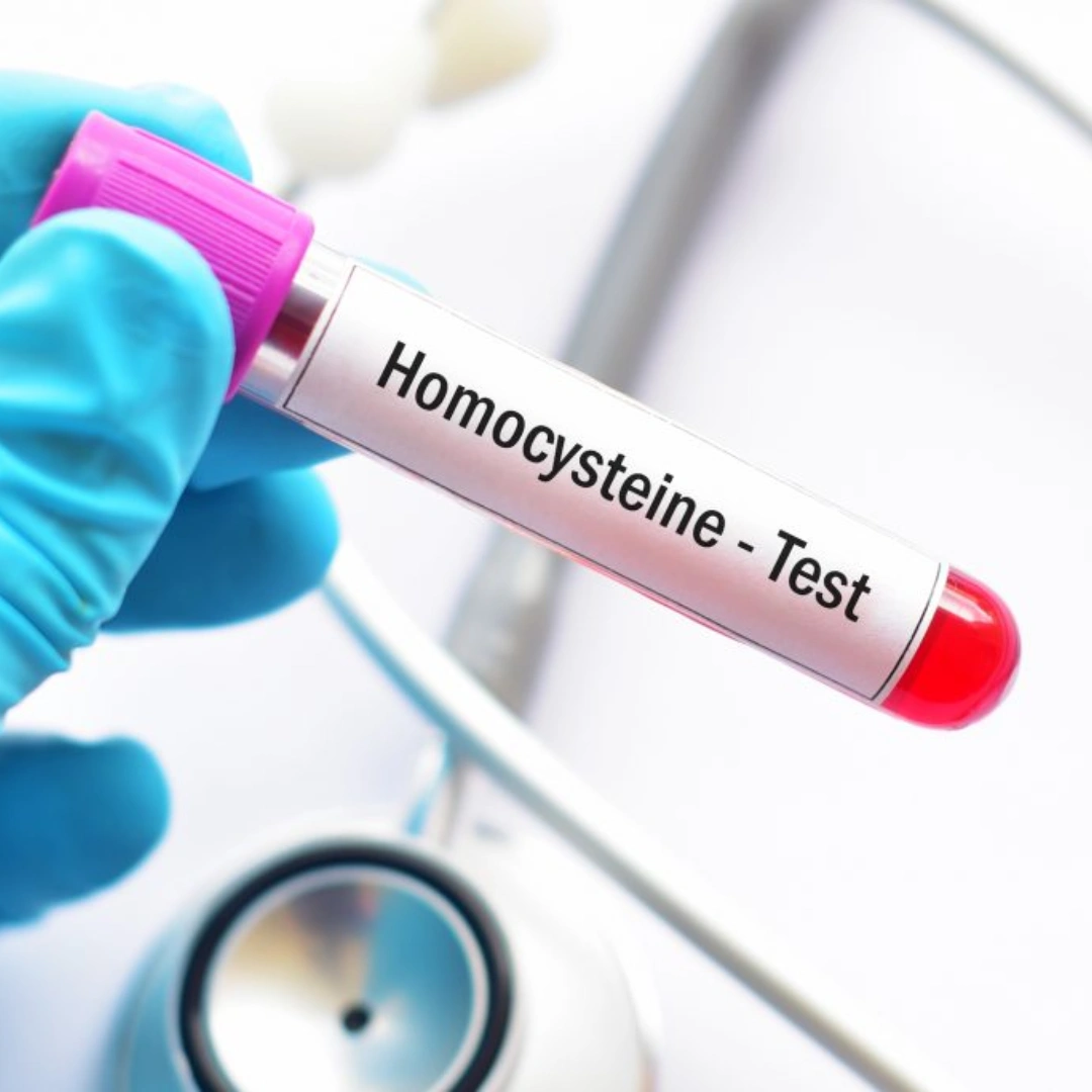 Homocysteine, Serum