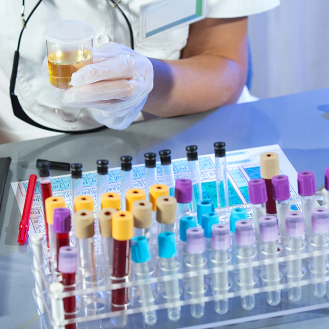 Immunofixation Urine