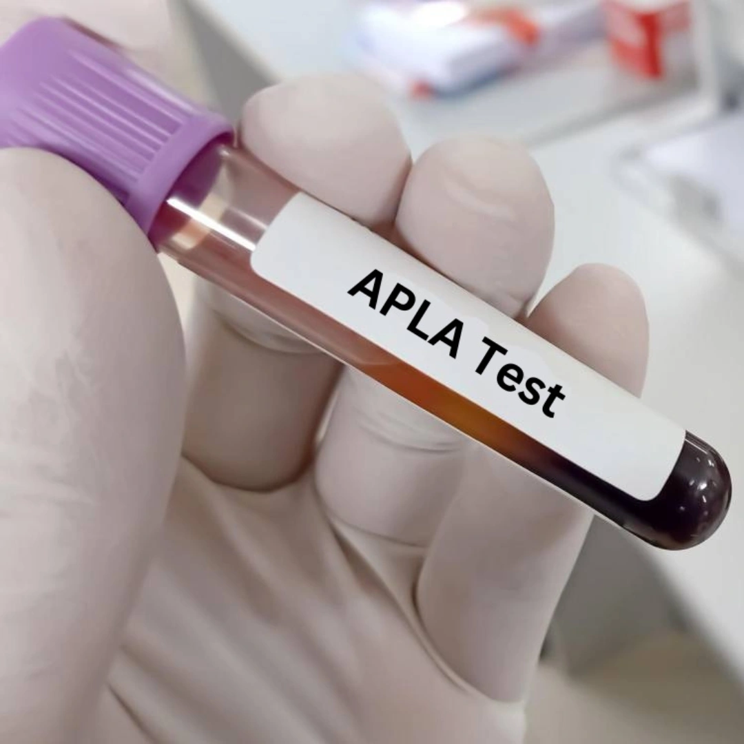 ANTI PHOSPHOLIPID ANTIBODY IGG, SERUM