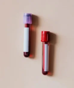 CHOLESTEROL LDL- DIRECT, SERUM