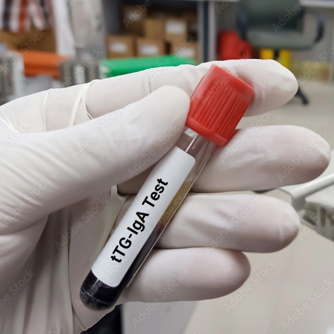 TISSUE TRANSGLUTAMINASE IGA, SERUM