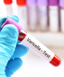 VARICELLA ZOSTER VIRUS (VZV) IGM ANTIBODIES