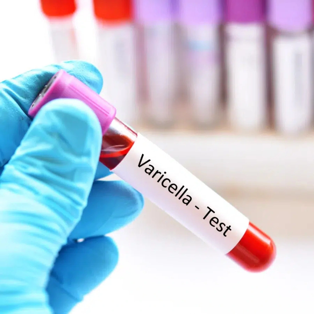 VARICELLA ZOSTER VIRUS (VZV) IGM ANTIBODIES