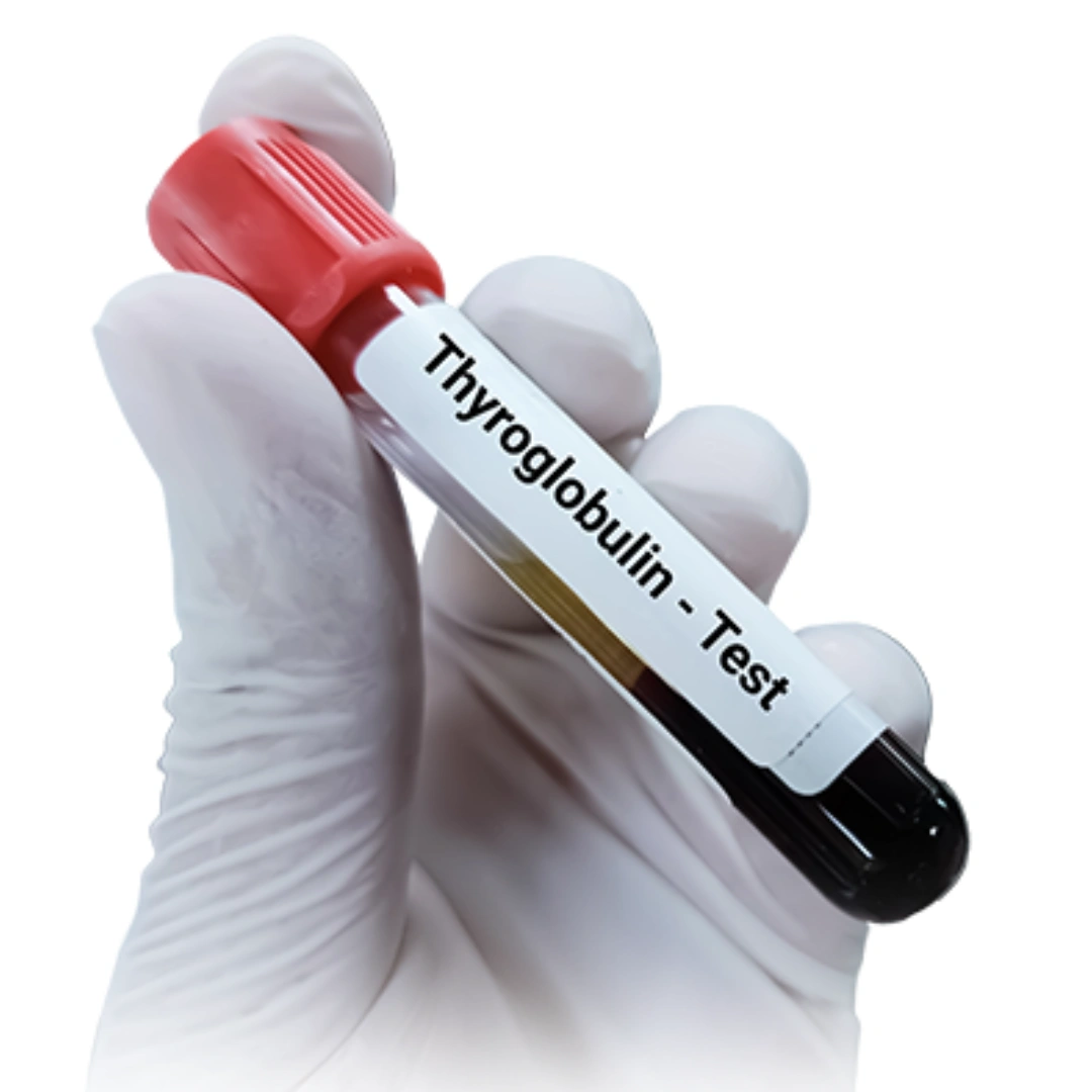 THYROGLOBULIN, SERUM