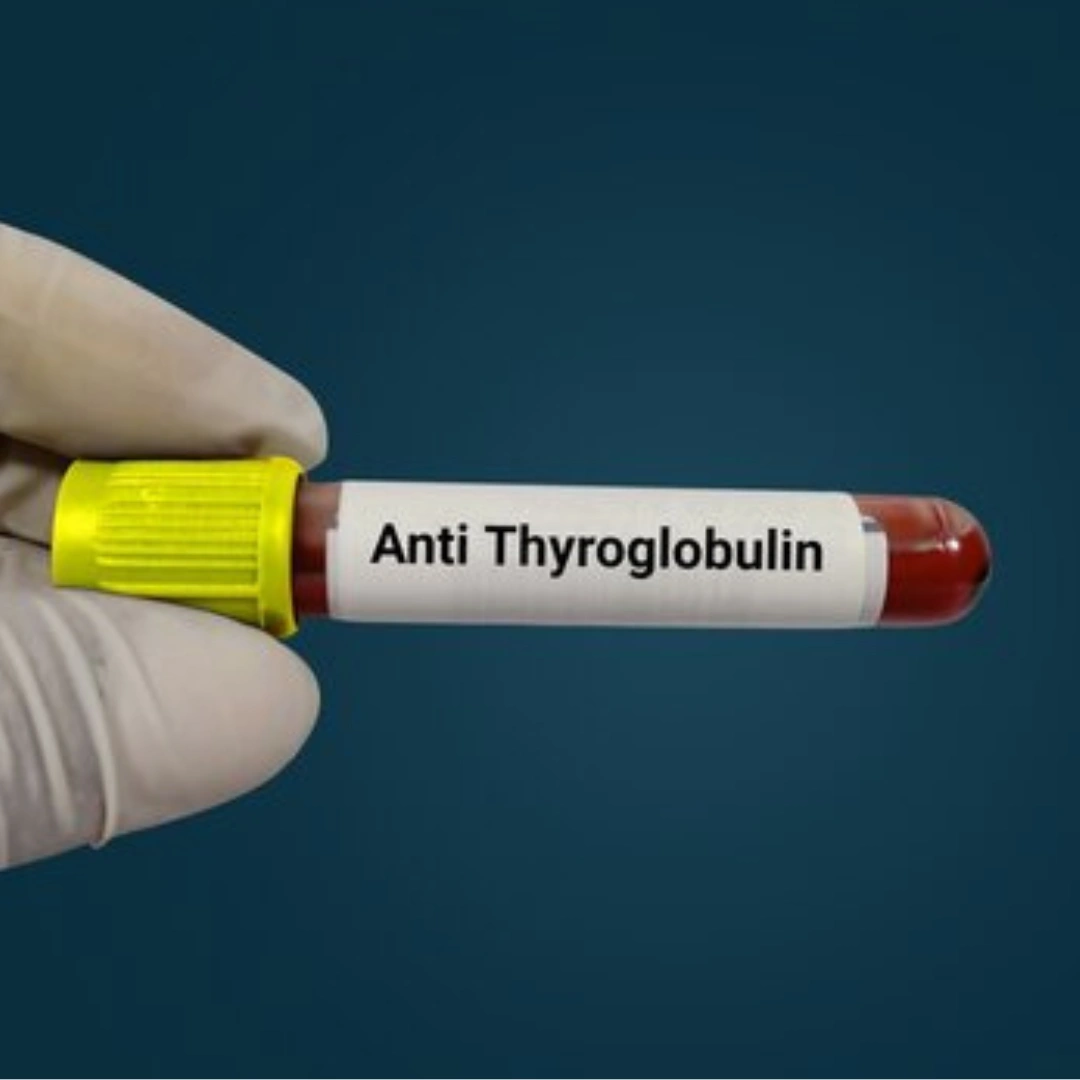 THYROGLOBULIN ANTIBODY (ANTI TG), SERUM