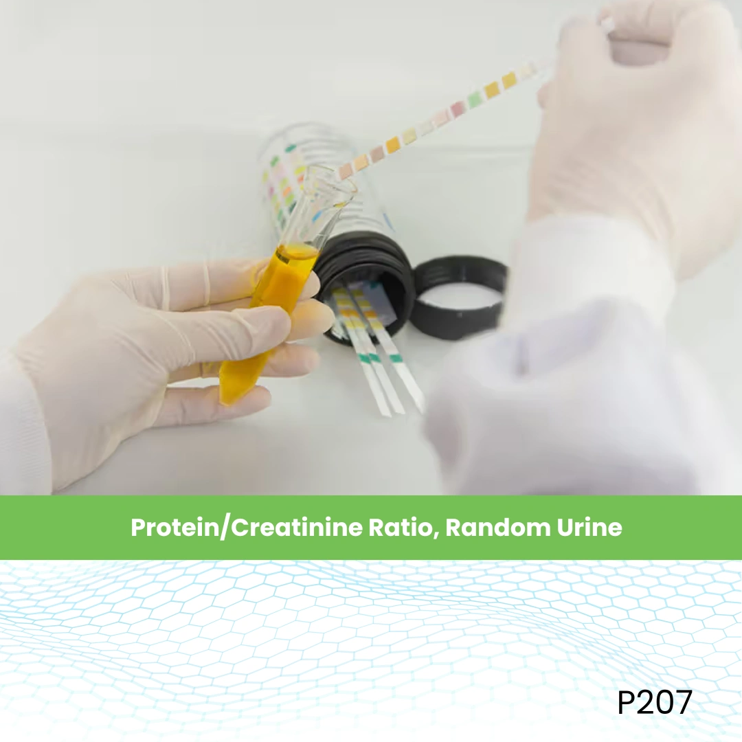 Protein/Creatinine Ratio, Random Urine