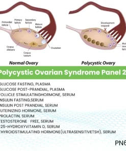 Polycystic Ovarian Syndrome Panel 2