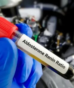 Aldosterone / Plasma Renin Direct Ratio