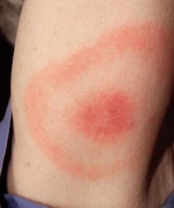 Lyme Disease (Borrelia Burgdorferi) Antibodies, Igg