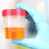 Manganese Spot Urine