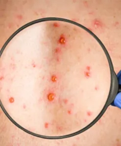 Measles Igg Antibodies