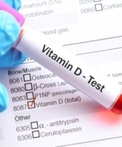 25-Hydroxy Vitamin D, Serum