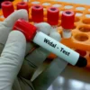 WIDAL TEST,  SERUM