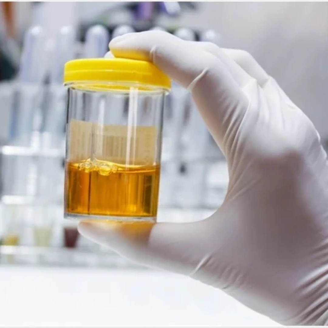 Nickel, 24 Hrs Urine