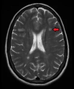 Multiple Scierosis Profile, Mini