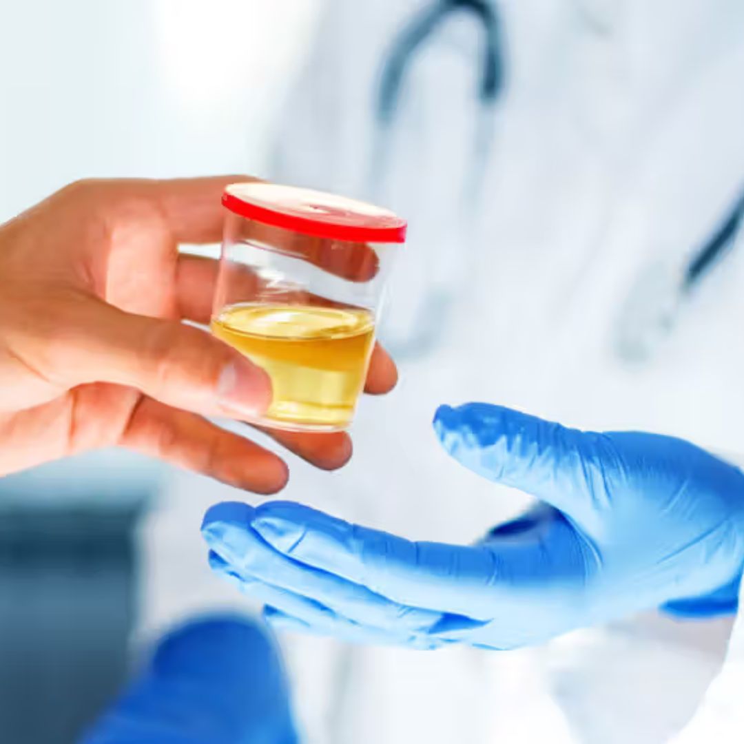 Microalbumin, Random Urine