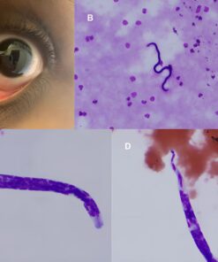 Microfilaria Smear, Whole Blood