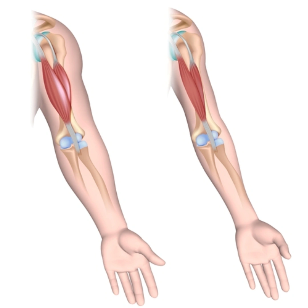 DUCHENNE MUSCULAR DYSTROPHY (DMD)-PCR