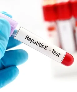 HEPATITIS E VIRUS IGM, SERUM