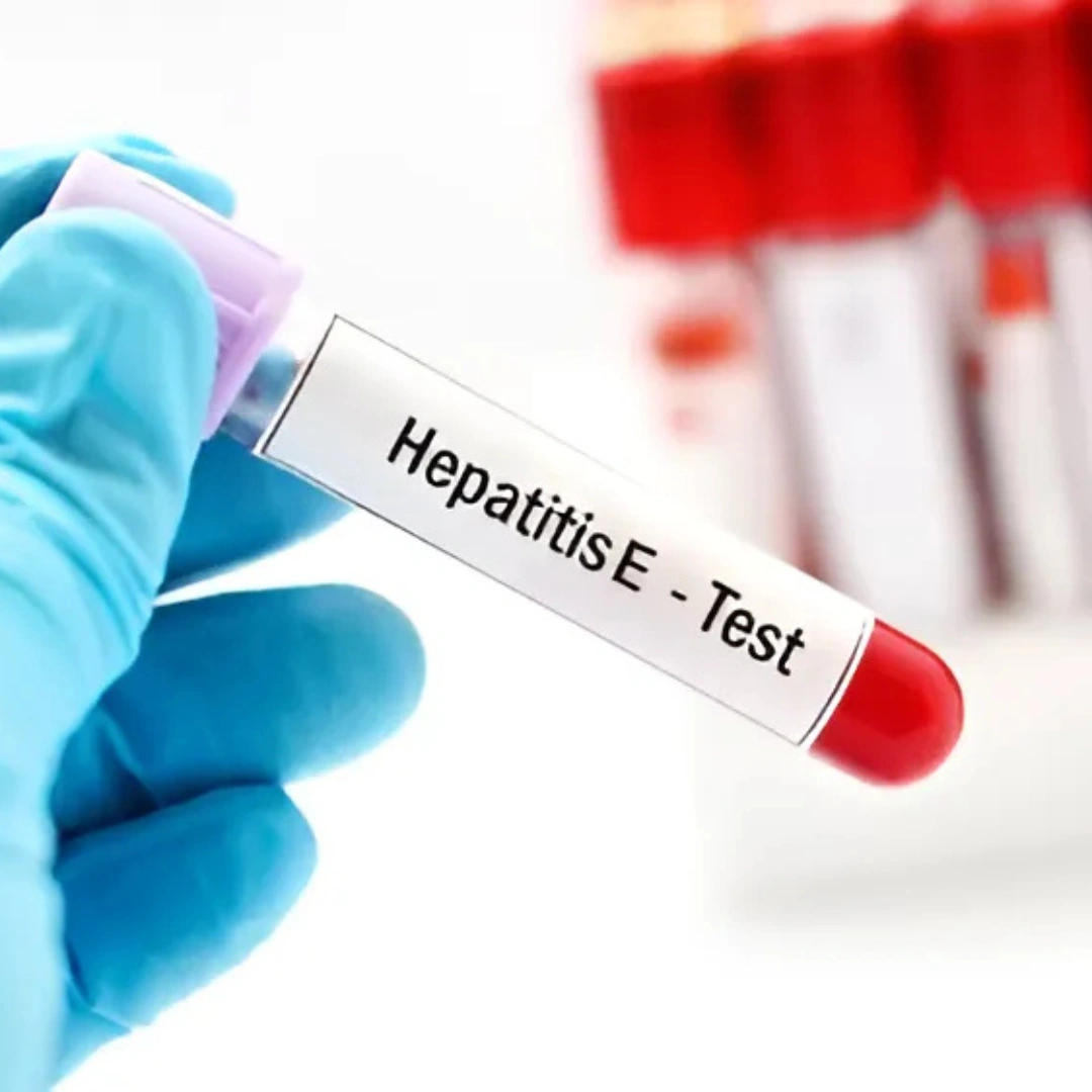 HEPATITIS E VIRUS IGM, SERUM