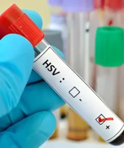 HERPES SIMPLEX VIRUS 2 IGM, SERUM