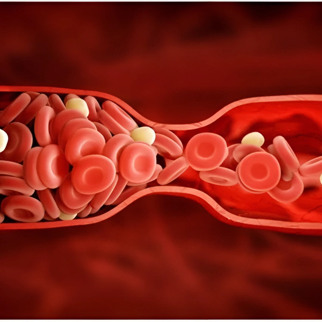 FACTOR - V (LEIDEN MUTATION)