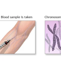 Peripheral Blood (Chromosome Analysis In Couple)
