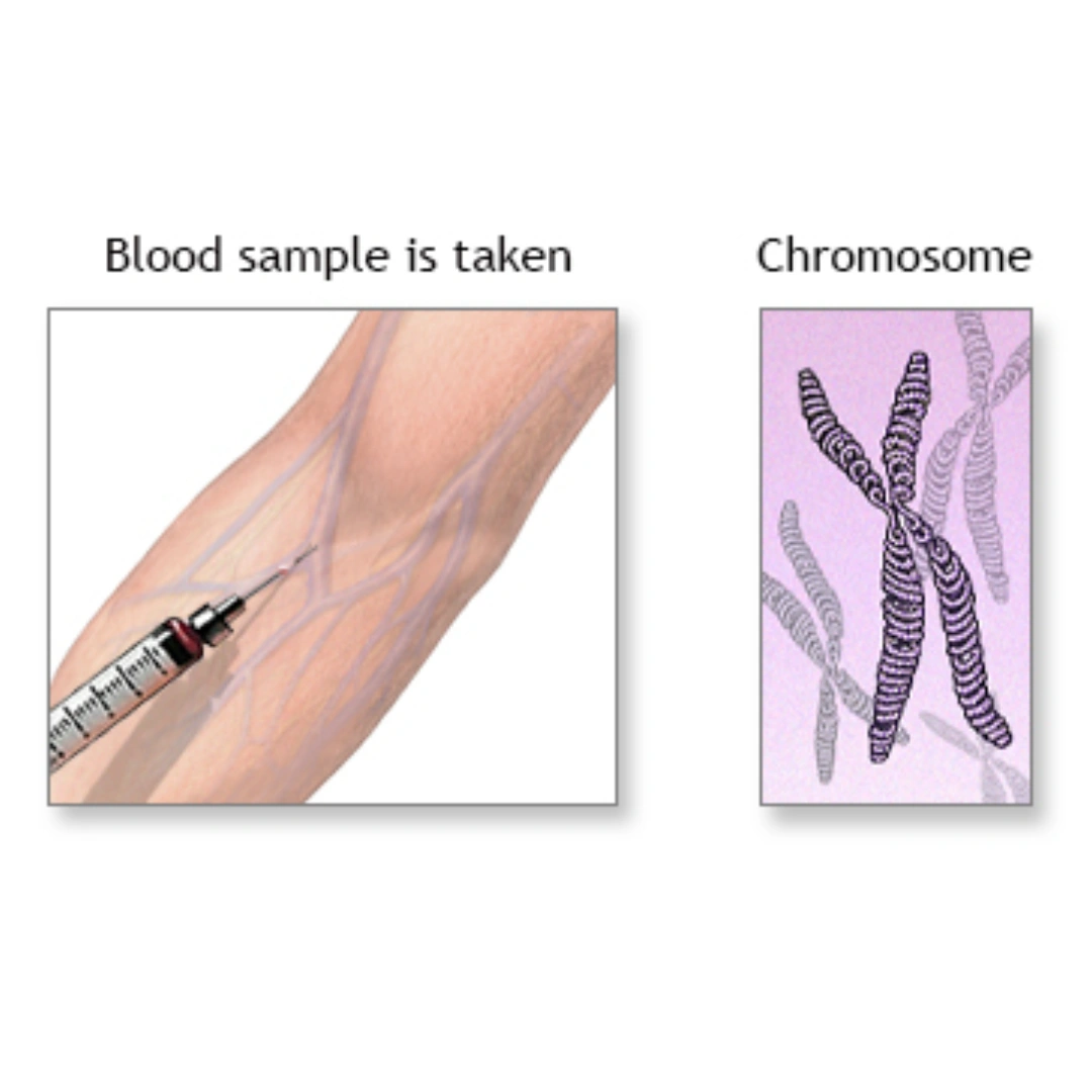 Peripheral Blood (Chromosome Analysis In Couple)
