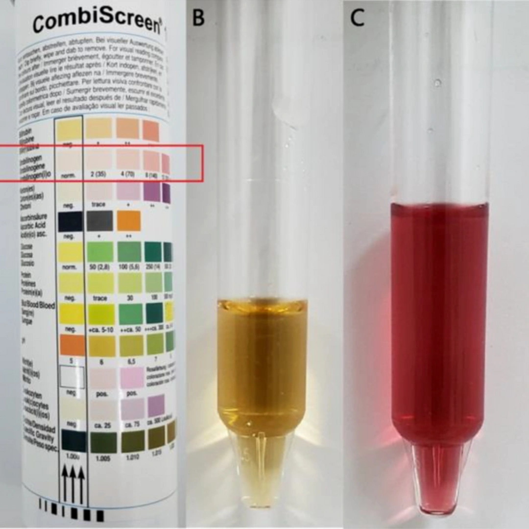 Porphobilinogen Urine